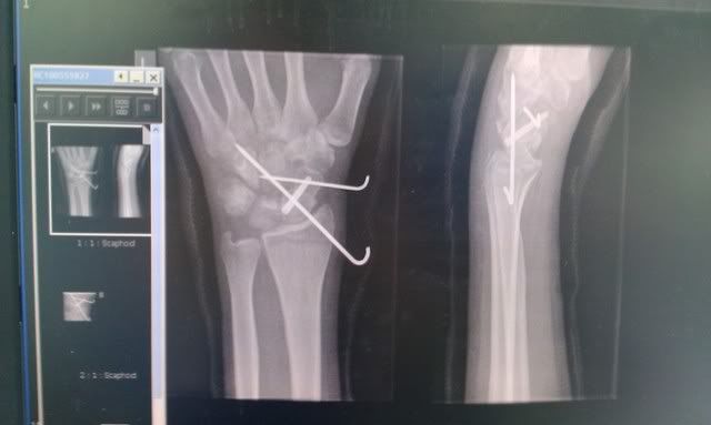 xraywrist.jpg